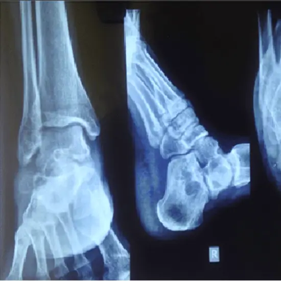 X-ray Right Heel LAT View
